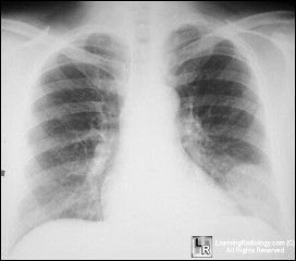 Pulmonary infarct